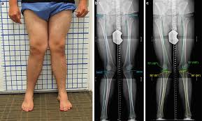 Image result for Femoral Retroversion
