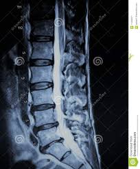 Discogenic Pathology Extrusion Nerve Root Mri Exam Stock Image Image Of Health Painful 114022671