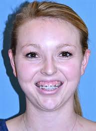 However, health sqyre does not offer home sleep tests through insurance at this time. Corrective And Orthognathic Jaw Surgery Dr Richard W Joseph