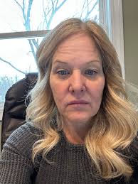 Facial Surgery Experience with Face-lift, Neck-lift, and Brow Lift