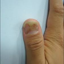 Toe fungus feeds on keratin and can affect the toes or toenails. Pdf Green Nail Syndrome Treated With The Application Of Tobramycin Eye Drop