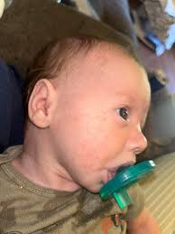 NEED ADVICE PLEASE, reflux?? CMPA? Does this look like a CMPA rash or just  maube acne? My six week old seems like he has all the symptoms for it  except blood stool.