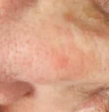 Image result for skin cancer on nose pimple