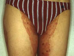 Collect, curate and comment on your files. Tinea Cruris Dermnet Nz