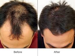 Hair Re Growth With Prp In Goa Panjim By Youthful Secrets Id 19180654291
