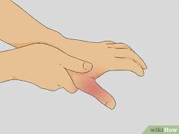 Underneath the post other teens have posted pictures of their own broken thumbs in a hall of horrors. How To Diagnose A Broken Thumb 15 Steps With Pictures Wikihow