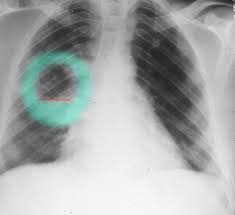 Image result for Lung Abscess
