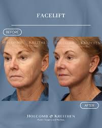 Hi Tampa! → Meet Dr. Salzman! 👋🏼 ⁠ Dr. Marc Salzman is a board-certified  plastic surgeon who has been practicing for over 30 years. He has been a  part of our team