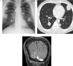 The sooner testicular cancer is caught, the better the chance of cure. Prognostic Factors Of Metastatic Testicular Non Seminomatous Germ Cell Tumors After Chemotherapy Sciencedirect