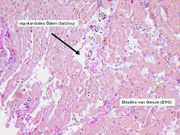 While most cases are produced by a viral infection, an inflammation of the heart muscle may also be instigated by toxins, drugs, and hypersensitive immune reactions. 15 Atypische Angina Pectoris Arztekammer Nordrhein