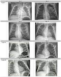 Frontiers | COVID-19 in 28-Week Triplets Caused by Intrauterine  Transmission of SARS-CoV-2—Case Report
