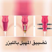 تضييق المهبل بالليزر في الحبيب احصلي علي حياة زوجية سعيدة من خلال عملية الليزر اعتذار و اسف