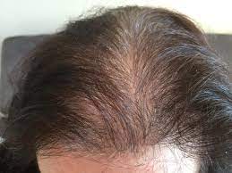 Une hypersensibilité héréditaire aux androgènes (hormones mâles secrétées en faible quantité par les ovaires et les la fue est donc préconisée pour les femmes ayant une petite surface à combler, un vide laissé sur les golfes ou zones temporales par des années. Dicso Iszap Medve Perte De Cheveux Femme Cause Tiburonsalmoninstitute Org