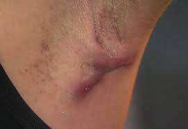 hidradenitis suppurativa kopek memesi hastaligi