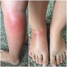 Symptoms may develop hours after a mosquito bite. Pin On Diy Colors