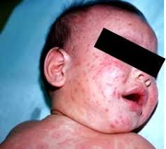 Image result for Erythema Multiforme Major