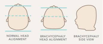 Image result for Positional Head Deformity