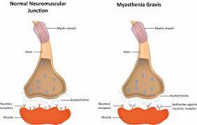 Argenx Antibody Proves Effective To Treat Myasthenia Gravis