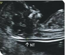 Nuchal translucency (nt) is a collection of fluid under the skin at the back of your baby's neck. Antenatal Screening And Testing For Down Syndrome And Other Conditions Healthed