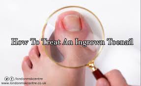 The nail becomes ingrown when the side of the nail cuts into the skin next to the if the nail fold becomes infected, symptoms of infection are increasing pain, swelling and redness near the ingrown nail, and yellow or green pus. Admin Author At London Musculoskeletal Centre Orthopedic Sports Medicine Page 5 Of 13