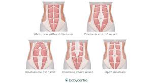 Diastasis recti abdominis (dra), commonly shortened to diastasis recti or diastasis, is the recent research on diastasis recti and crunches. Diastasis Recti Babycentre Uk