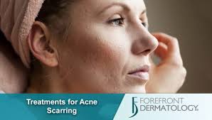 How to choose the best best sulfur acne treatment. Treatments For Acne Scarring Forefront Dermatology