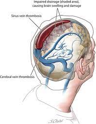 Blood clots can reduce the flow of blood throughout your body. Cerebral And Sinus Vein Thrombosis Circulation