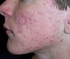 Image result for acne face