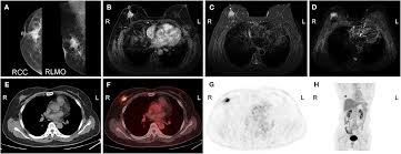 Breast cancer — comprehensive overview covers prevention, symptoms, diagnosis and treatment of breast cancer. Frontiers Progress And Future Trends In Pet Ct And Pet Mri Molecular Imaging Approaches For Breast Cancer Oncology