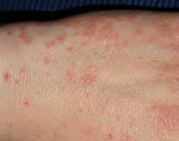 Scabies is a transmissible ectoparasite skin infection caused by tiny mites of the species sarcoptes scabiei, with the disease characterized by intense itching (pruritus), a rash, and secondary infection, as well as superficial burrows where mites tunnel under the skin of their hosts. My Atypical Scabies Symptoms Unusual Signs Of Mites That Doctors Don T Recognize Patient S Lounge
