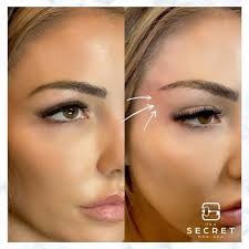 We hoped you enjoyed this video and stay tuned for weekly videos! Its A Secret Med Spa On Twitter Introducing The Cat Eye Look We Use Pdo Threads To Raise Your Eyebrows And Give You That Instant Lift It S A Non Surgical Minimally