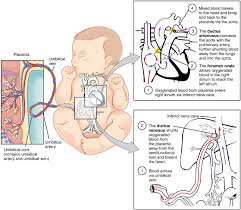 Image result for Delayed Transition from Fetal Circulation