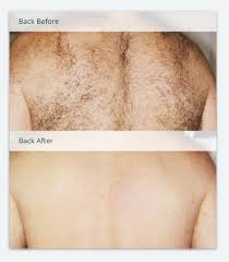 However, the results of laser hair removal are that it gradually reduces hair growth. Before After Photos Of Laser Hair Removal Milan Laser