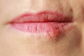 Genital herpes oral sex