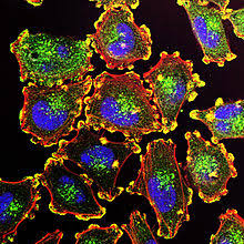 Here are 10 more facts about prostate cancer. Melanoma Wikipedia