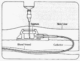 Image result for port a cath images