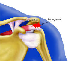 •akromiontypen nach bigliani •typ 1: Impingement Syndrom Behandeln Dr Ullmann Munchen