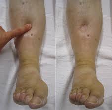 Edema - Wikipedia, la enciclopedia libre