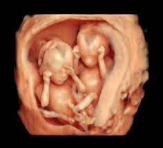 Besuchen sie germany.sonosite.com für weitere videos.mit dem einsatz von 3d animierten videos können wir ihnen nun in neuer darstellung zeigen, wie portable. 3d 4d Ultraschall Praxis Fur Pranatale Diagnostik In Munchen