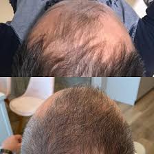 Stem cell treatment for hair loss philippines it's been theorised for years, but now human stem … cells and confirmed their ability to induce hair growth when. Hair Center Kierach Warsaw Poland