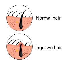 Causes of infected ingrown hair. How To Get Rid Of Ingrown Hair Tips For Ingrown Hair Removal