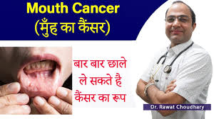 तुरंत पहचानें डायबिटीज के लक्षण और शुगर के लक्षण : Mouth Cancer Treatment Symptoms Of Mouth Cancer Cause Of Cancer Youtube
