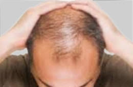 Female hair loss treatment with homeopathy offers a conservative course of medicines that work gradually over time to fix the problem from the root. Male Pattern Baldness Dr Aditis Advanced Homeopathy