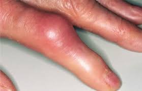 Pervye Priznaki Podagry Na Rukah Podagra Na Rukah Simptomy Diagnostika I Lechenie Kak Lechit Podagru S Pomoshyu Lekarstvennyh Sredstv