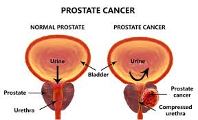 Although the percentage of cases in men is much lower than in women, male breast cancer accounts for a por. Prostate Cancer Learn About The Symptoms Prevention And Treatment Medanta