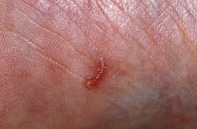 Image result for scabies on humans