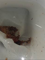 Image result for blood in stool human poop