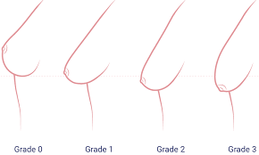Look and feel better with breast enlargement surgery (augmentation) from the experts at aurora clinics. Breast Implants Saline Silicone Hydrogel Wellness Kliniek