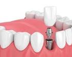 How Painful is Dental Implant Surgery