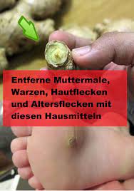 Entferne Muttermale Warzen Hautflecken Und Altersflecken Mit Diesen Hausmitteln Heike Roth Muttermal Altersflecken Und Hautflecken